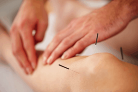 acupuncture acupuncture
